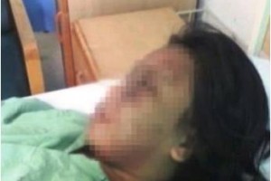 Norfia Linda, TKI asal Lombok, disiksa hingga babak belur oleh majikannya di Malaysia